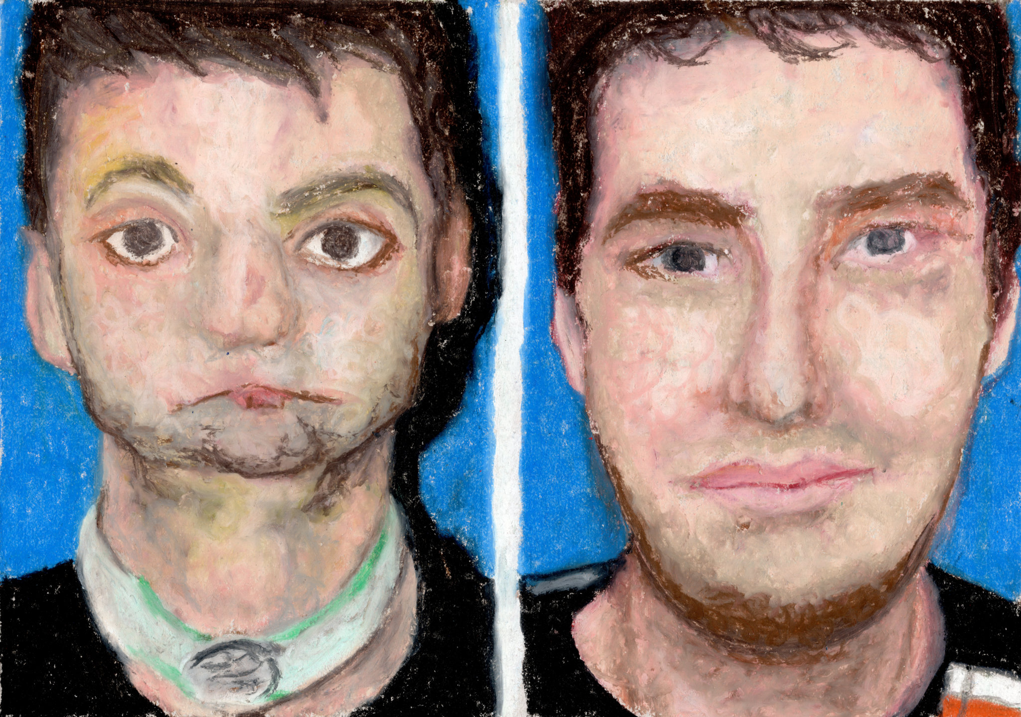 Richard Norris / First facial transplant