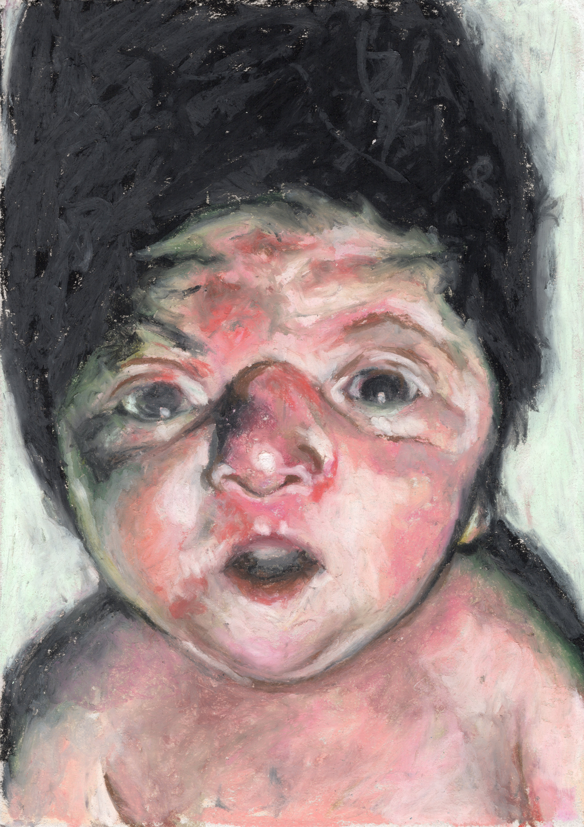 Helmut / Newborn / Apert syndrome