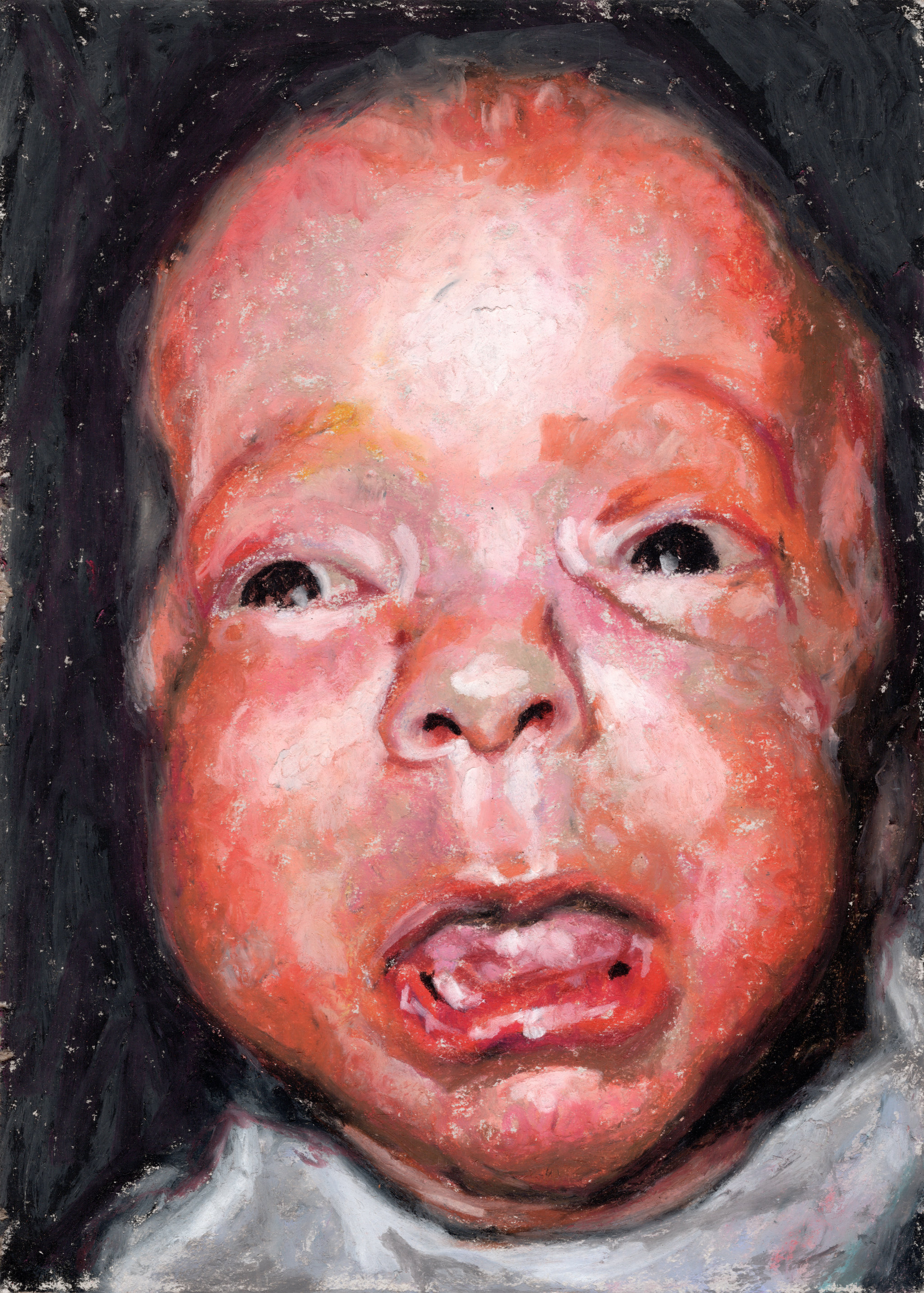 Joachim / Newborn / Osteogenesis imperfecta
